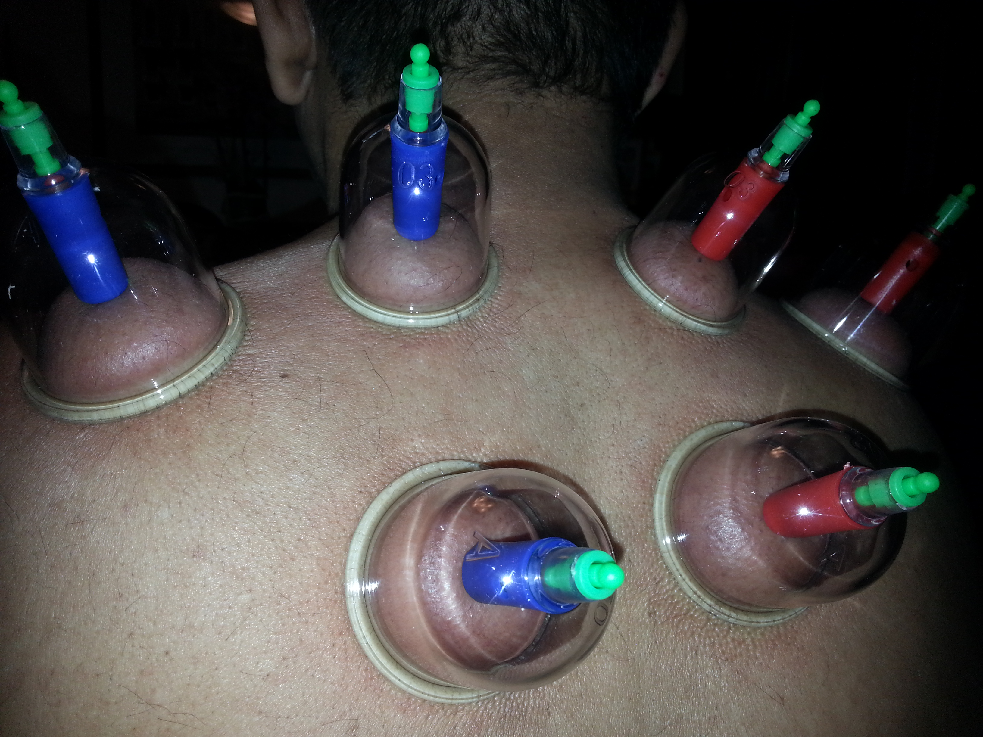 Manuelle Schröpftherapie